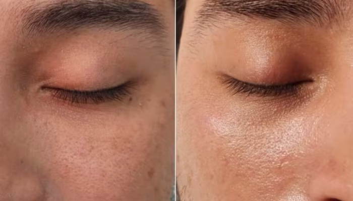Tratamiento facial AquaPure en Marbella para limpieza profunda, hidratación intensa y piel radiante